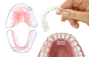 التقويم الشفاف (إنفيزالاين Invisalign)
